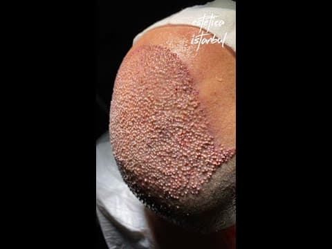 Hair Transplant with Estetica Istanbul — Patient Review