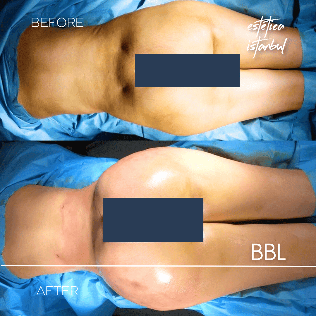 Botched BBL: BBL Revision Preparation