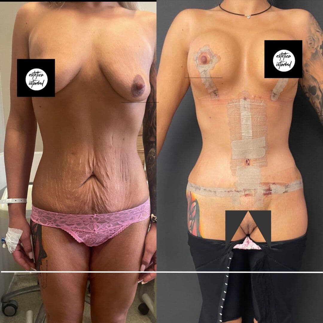 Plastic Surgery Tips to Have a Slimmer Body