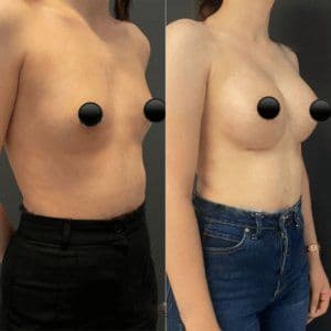 Breast Augmentation Surgery After