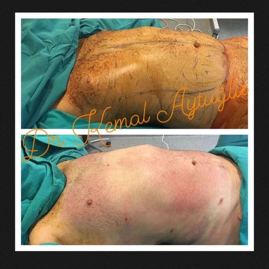 Liposuction vs Karın Gerdirme: Hangi Vücut Konturlandırma Prosedürü Sizin İçin Doğru?