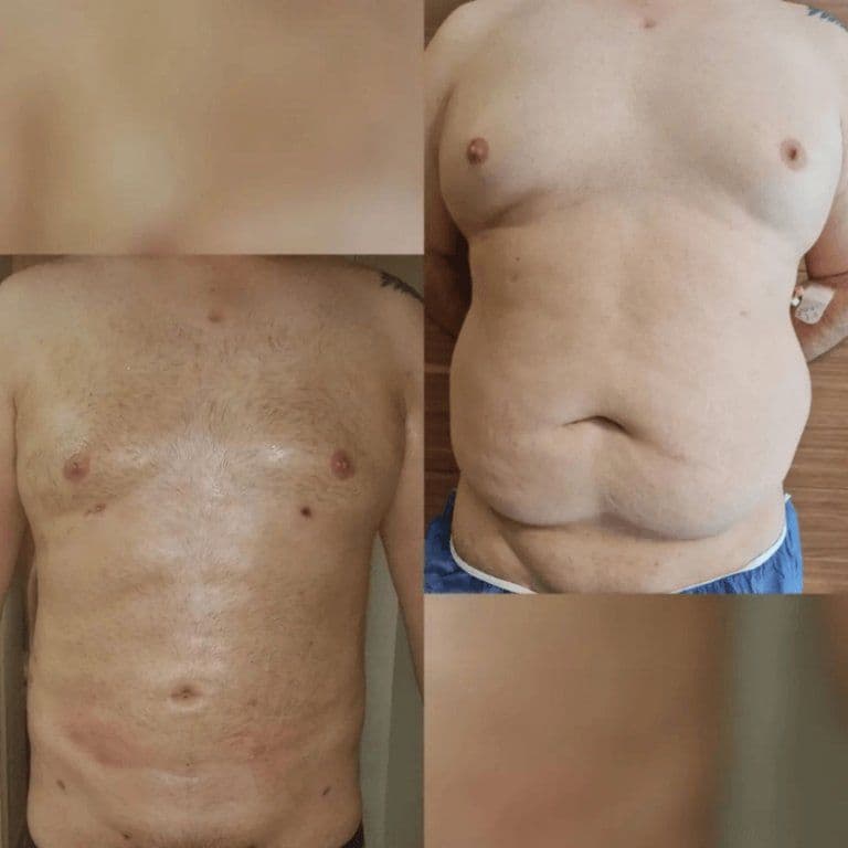 Lipo Surgery Before And After