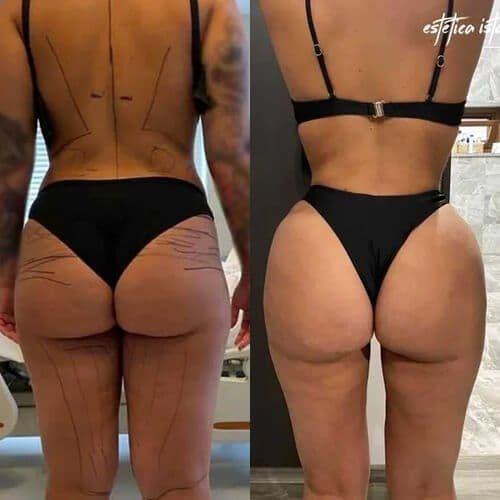 Brazilian Butt Lift Before And After