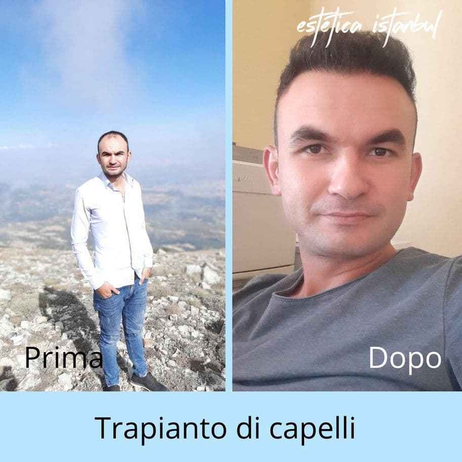 Hair Transplant Before After 09