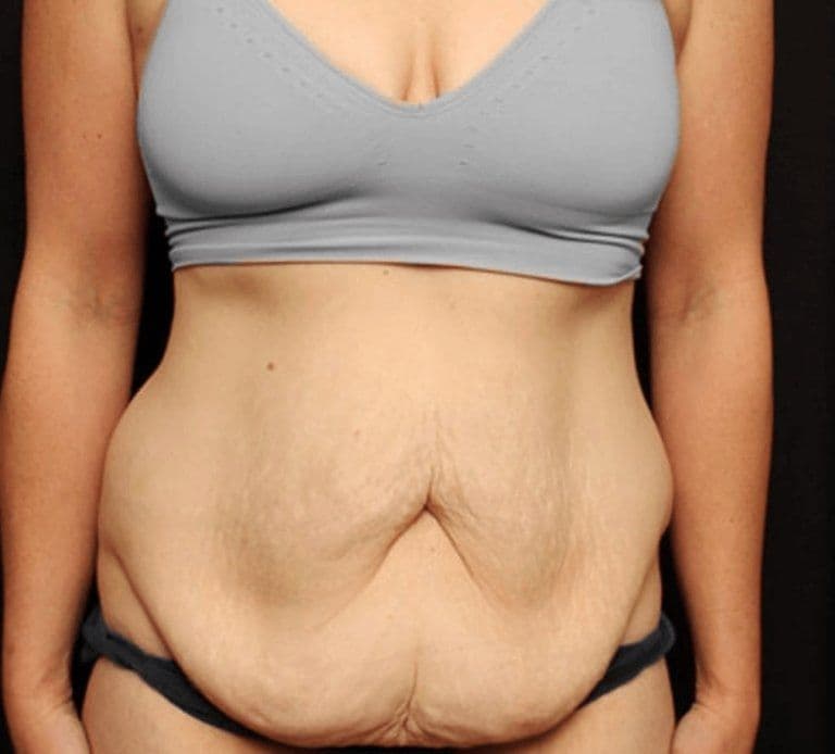 Tummy Tuck Surgery Turkey Before After
