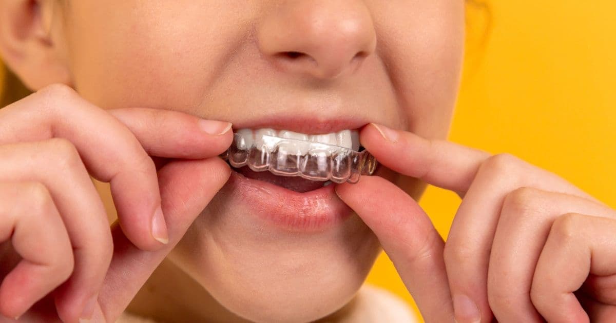 Hollywood Smile in Turkey: Complete Guide to Dental Veneers in Istanbul