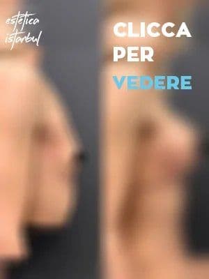 Breast Before After It 1