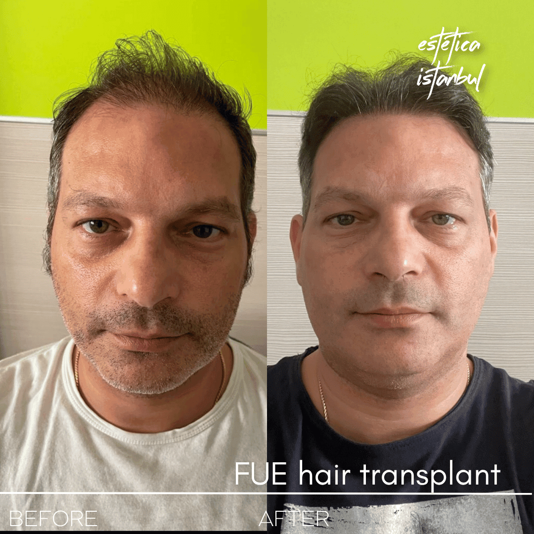 Using Shampoo After Hair Transplant