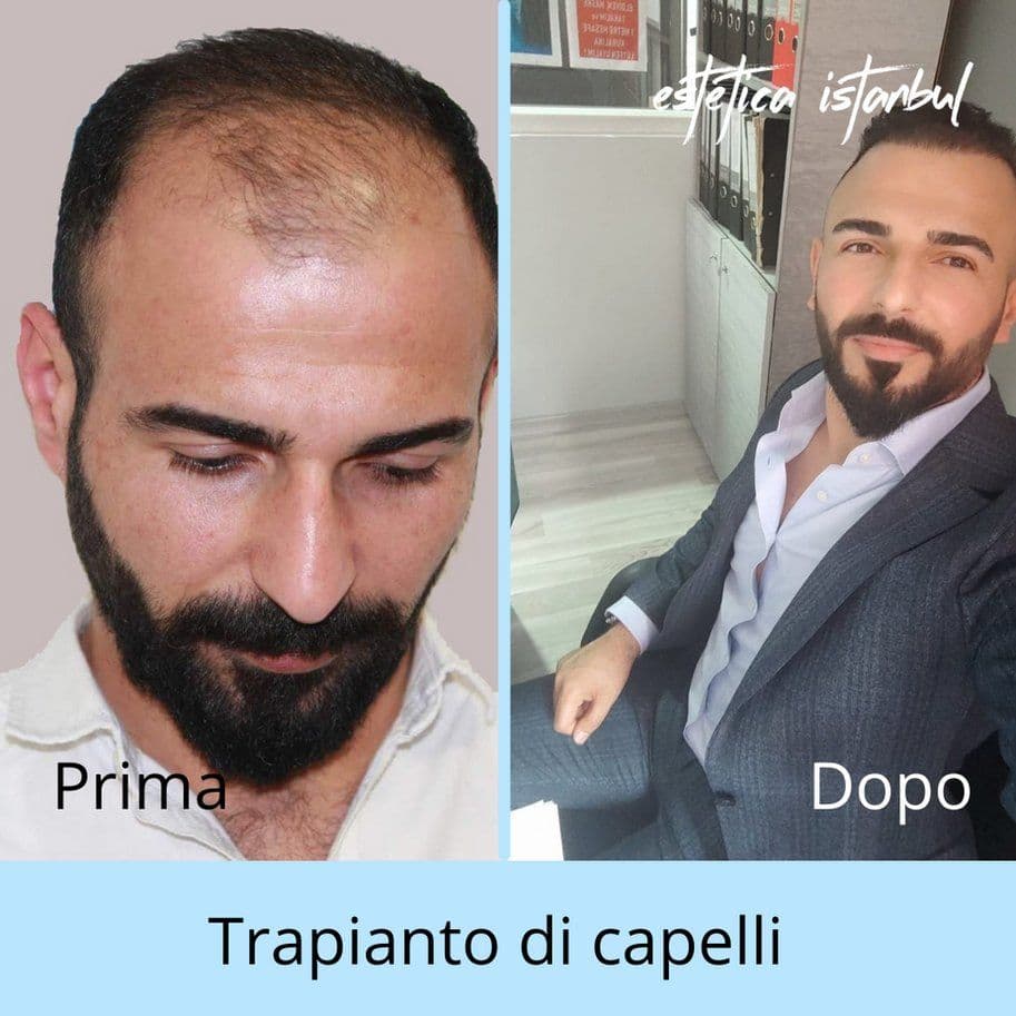 FUE vs DHI Saç Transplantı: Sizin İçin Hangi Teknik Doğru?