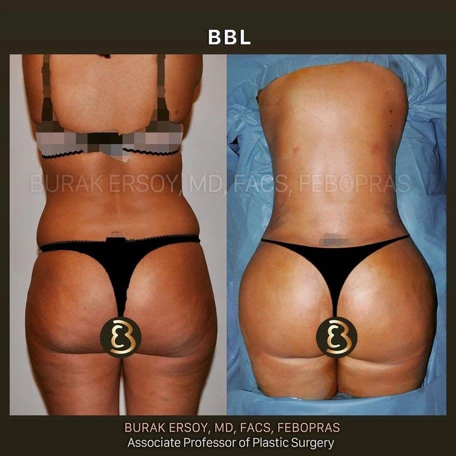 Brazilian Butt Lift Before After 10