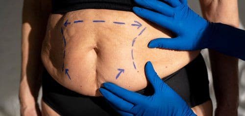 Başarısız Karın Germe: Nedenleri ve Nedenleri Çözümler