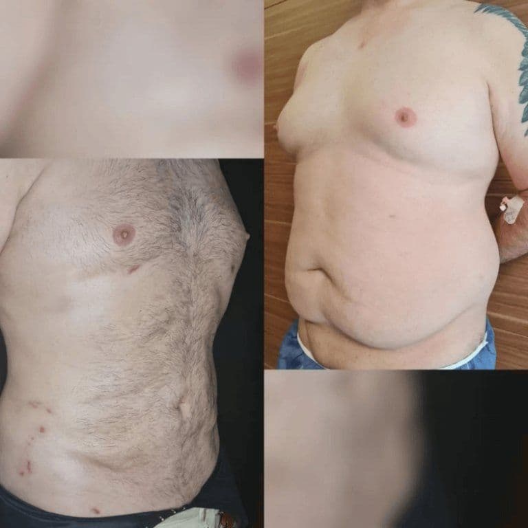 Lipo Surgery Before After Turkey