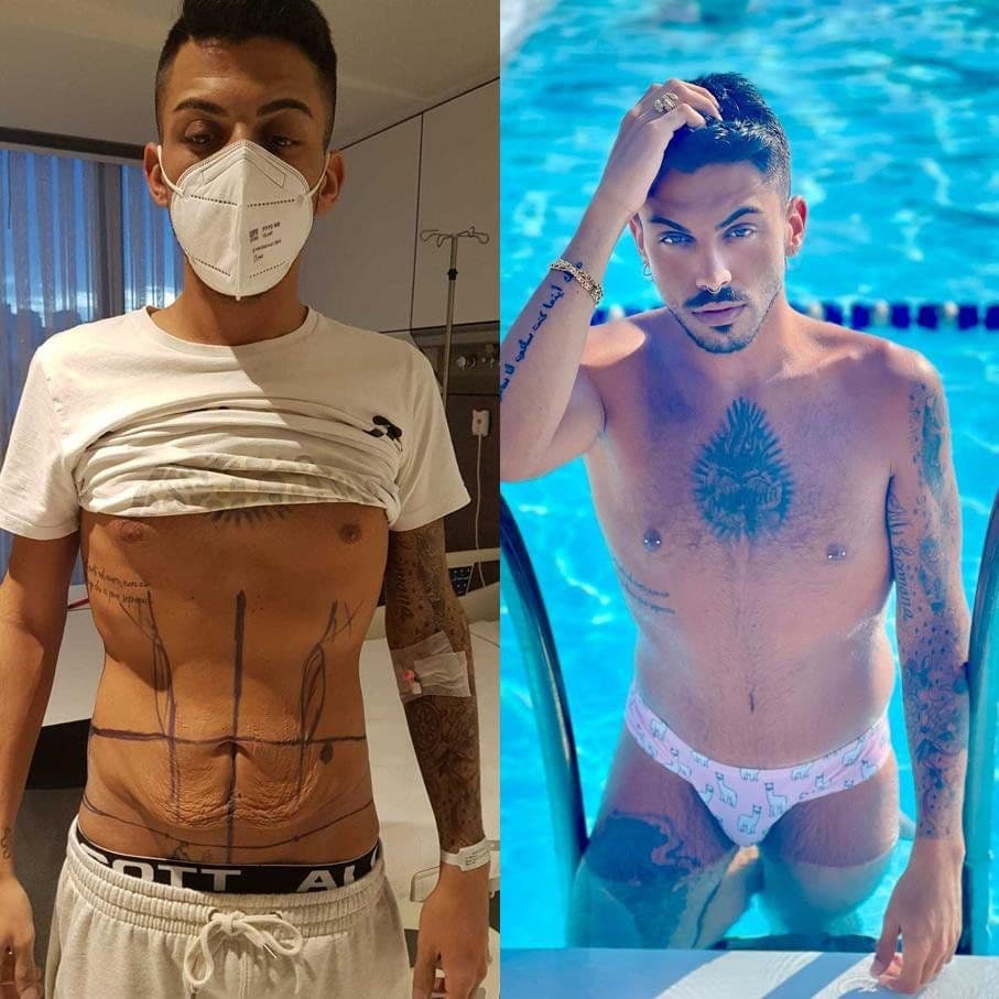 Estetica Body Lift Surgery Before After