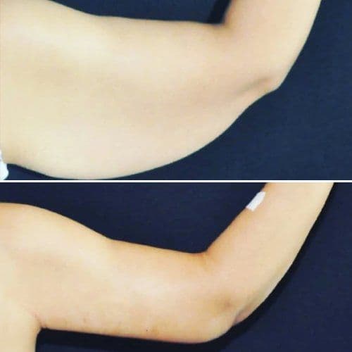 Arm Lift Before After