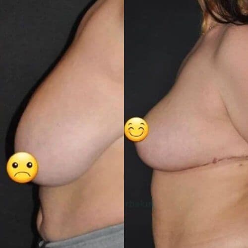Breast Reduction Before And After Turkey