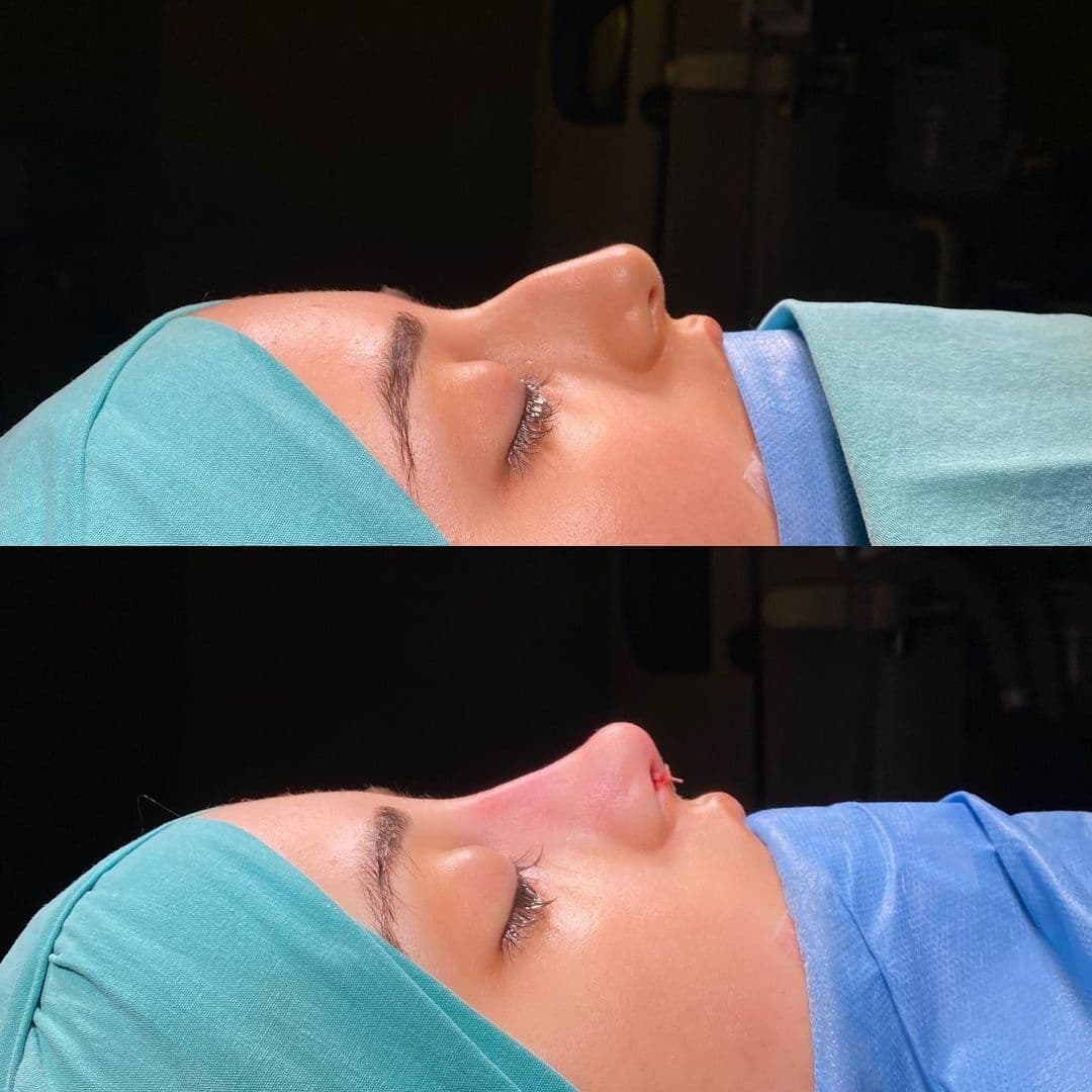 Rhinoplasty Surgery Before After