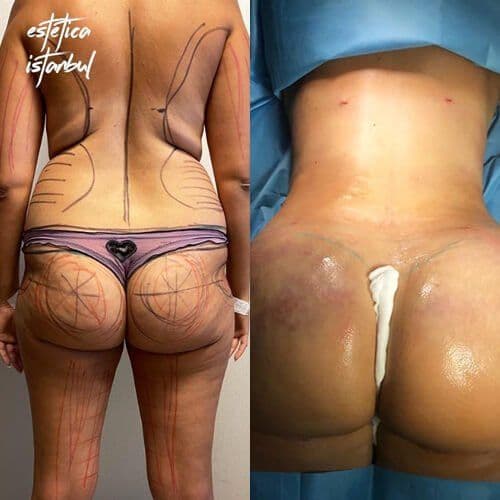 Brazilian Butt Lift Before After
