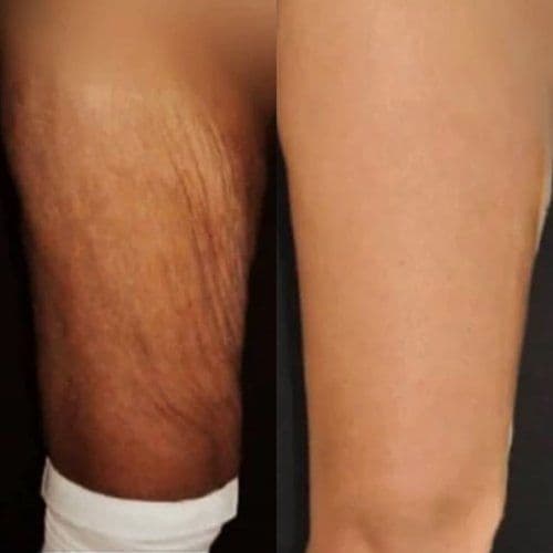 Thigh Lift Surgery Before After Turkey