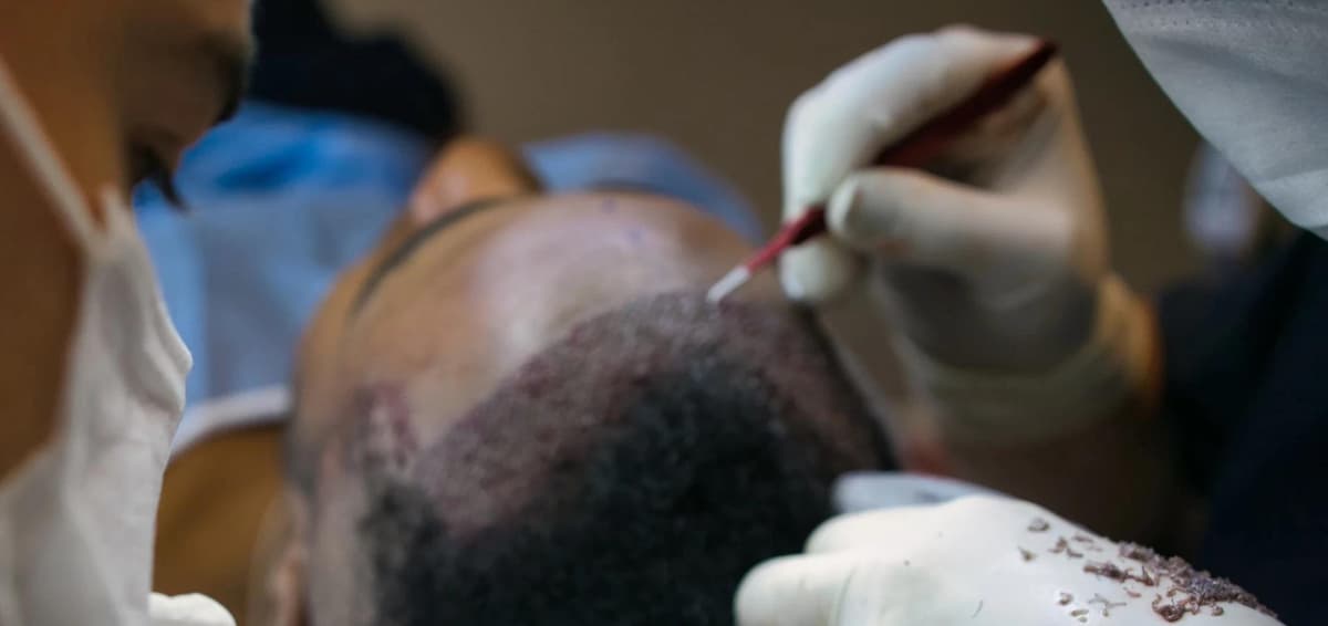 Greffe de Cheveux DHI in Istanbul — Estetica Istanbul