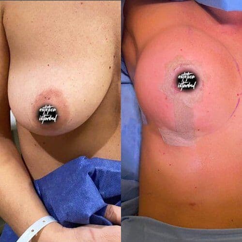 Breast Lift Before And After