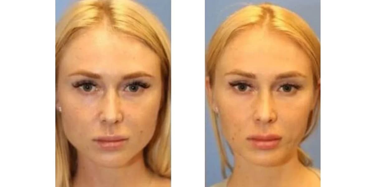 Bichectomy Before After 02 2