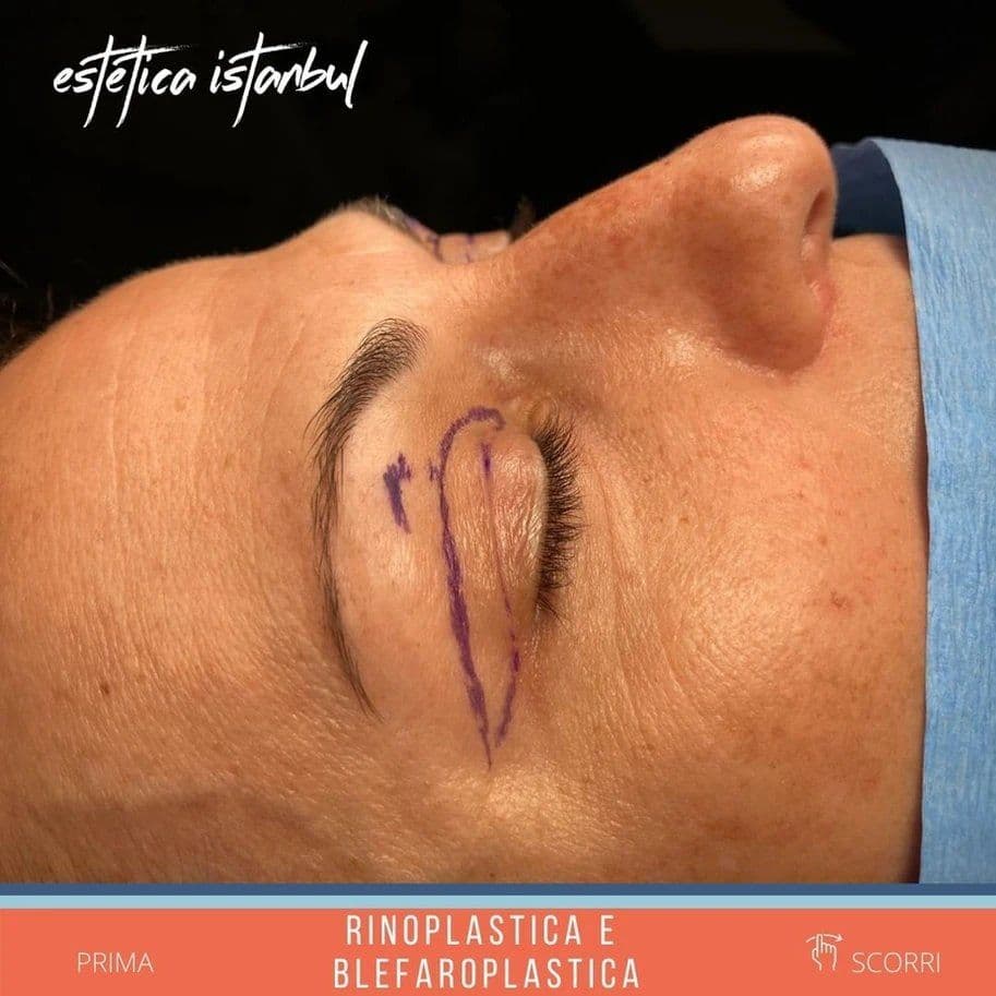 Rinoplastica Before After 15