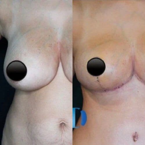 Breast Reduction Before After