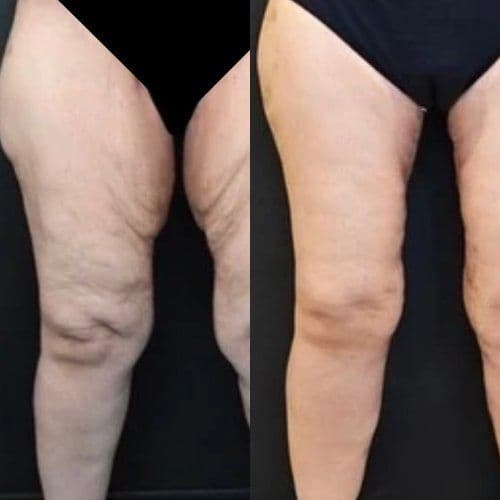 Thigh Lift Before After Turkey