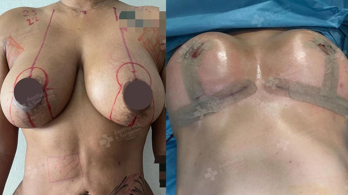 Hangisi Daha İyi Meme Dikleştirme mi, Meme Büyütme mi?