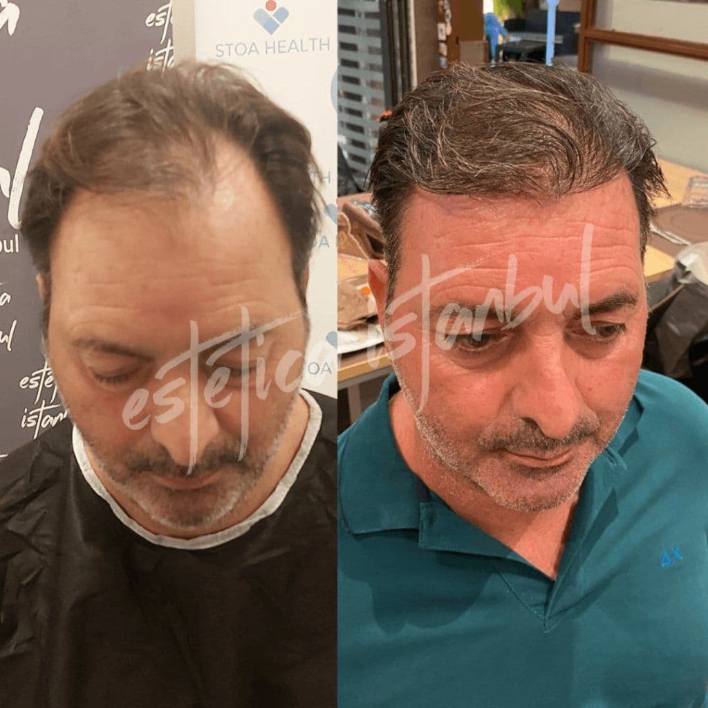 Taç Saç Ekimi Türkiye