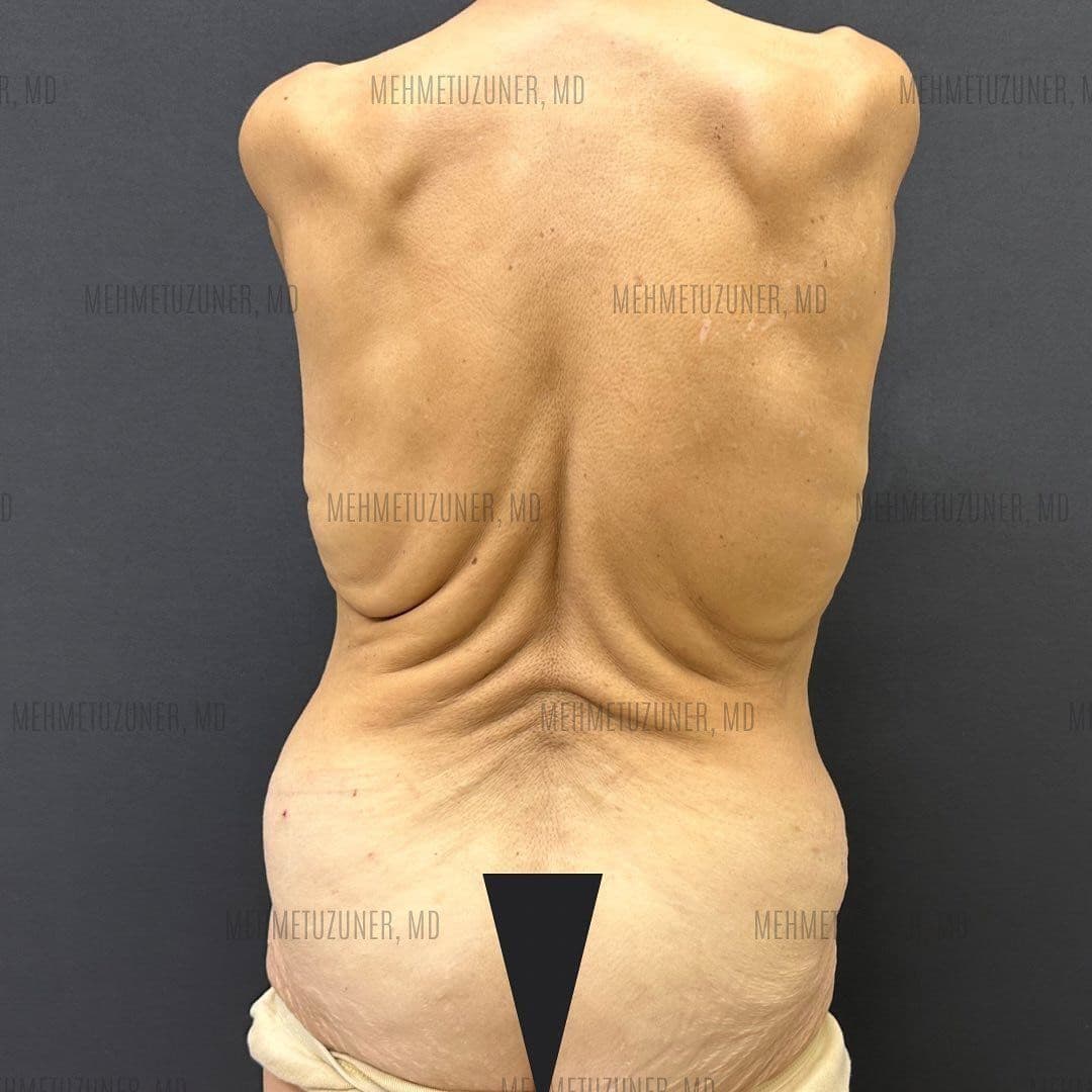 İstanbul'da Gastrik Manşon Cerrahisi: Tam Hasta Rehberi