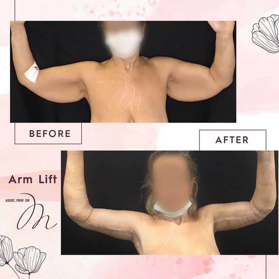 Arm Lift Before After 16