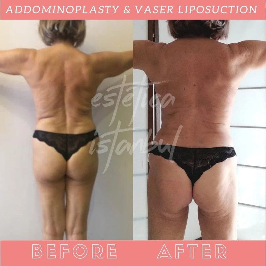 Tummy Tuck Before After 13