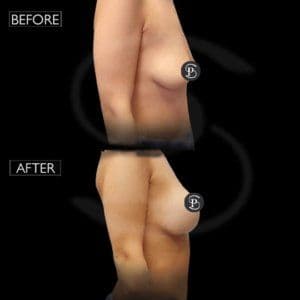 Breast Lift Surgery Before After