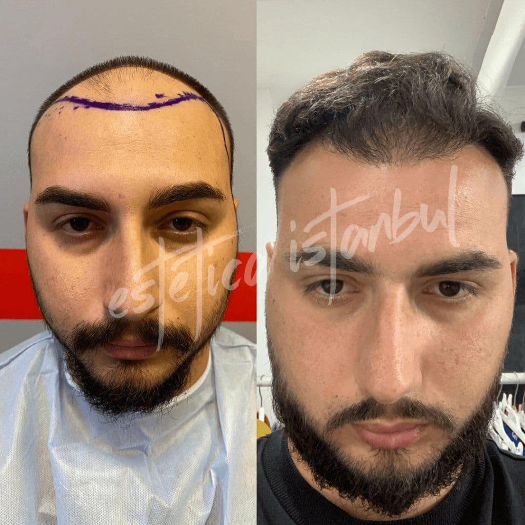 Male Hair Transplant Turkey Before After