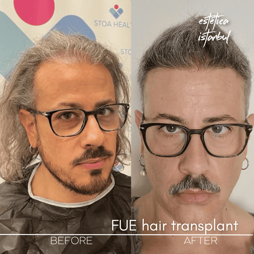 First Haircut After Hair Transplant: The Ultimate Guide