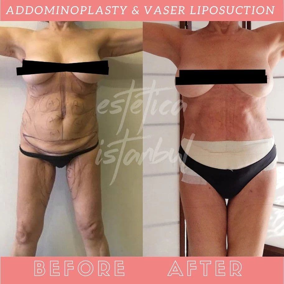 Karın Germe Kurtarma: Haftalık Tam Rehberiniz