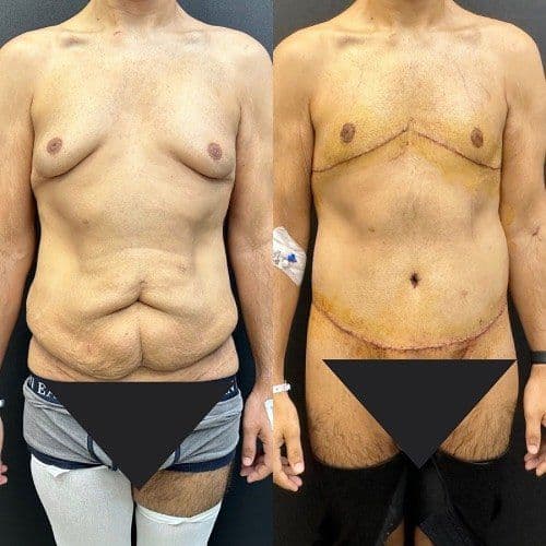 Male Bariatric Surgery Before After Photos In Turkey