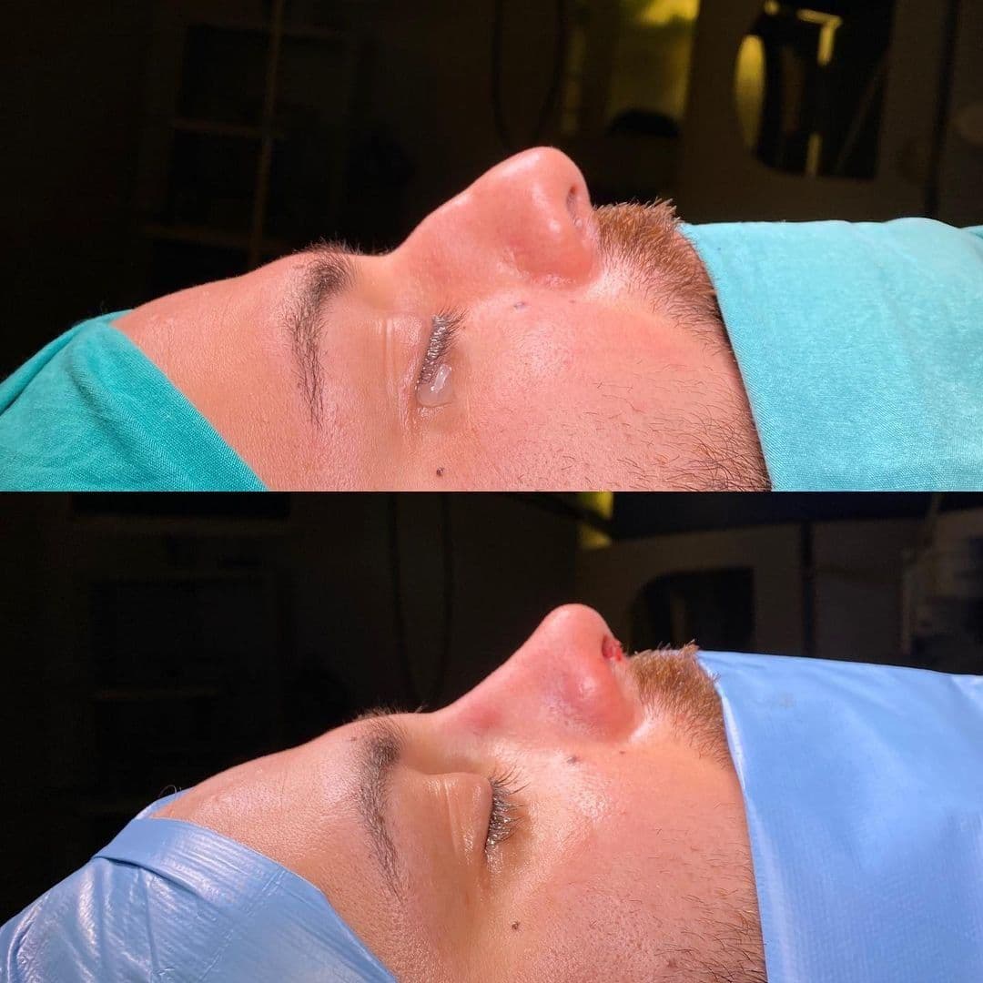 Rhinoplasty For Men Before After