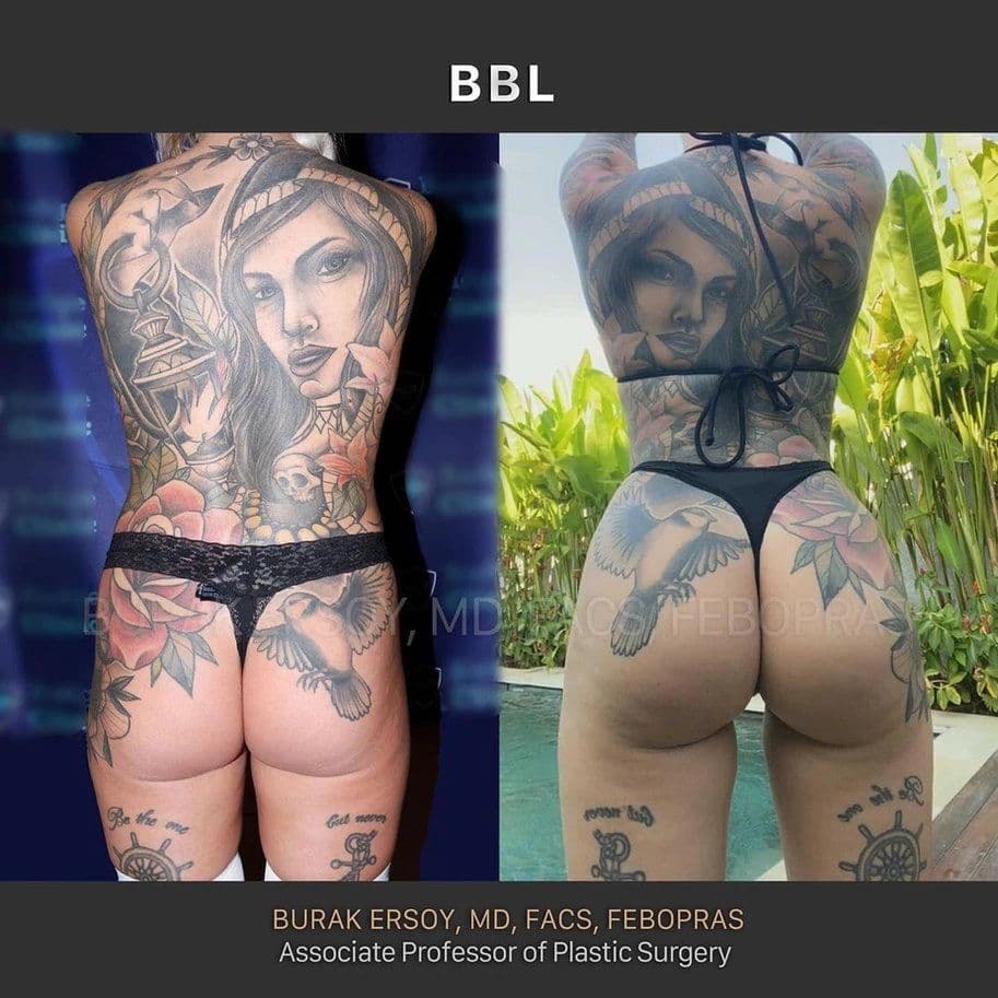 BBL Güvenliği: İstanbul'un En İyi Cerrahları Riski Nasıl Minimiye Ediyor