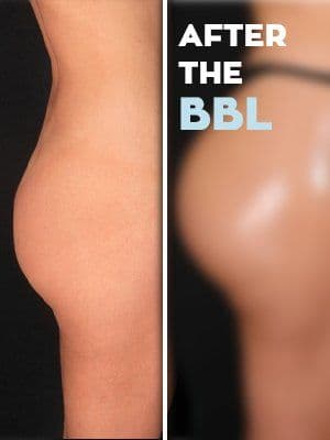 Bbl Before After