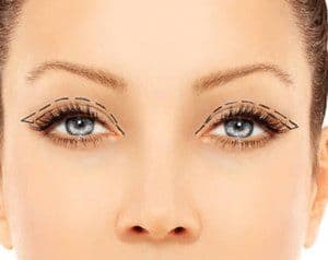 What Should Be Considered Before Eyelid Aesthetics Blepharoplasty