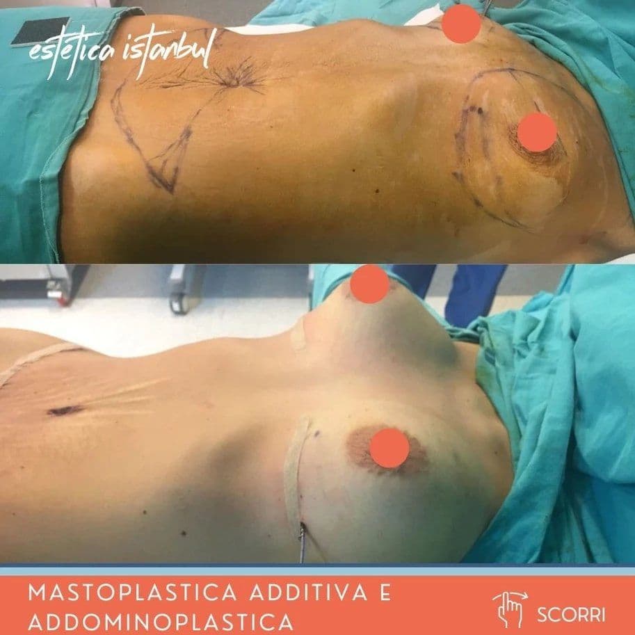 Karın Gerdirme Iyileşmesi: Tam Haftalık Rehberiniz (2026)