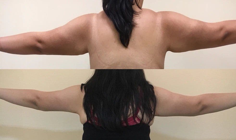 Arm Lift Before After 09 1