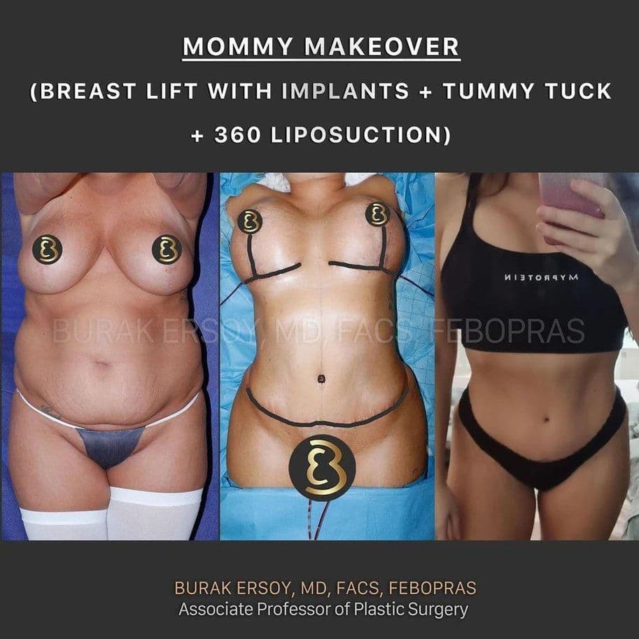 Mastopexie Before After 06