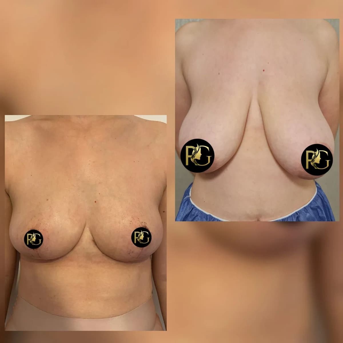 Breast Reduction Surgery Before And After Turkey