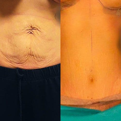 Tummy Tuck Turkey Before After
