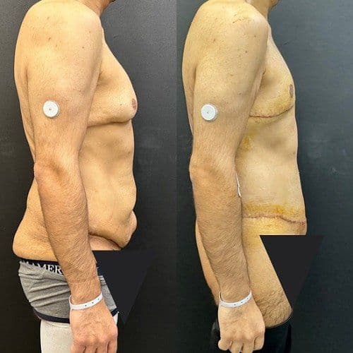 Male Bariatric Surgery Before After Photos