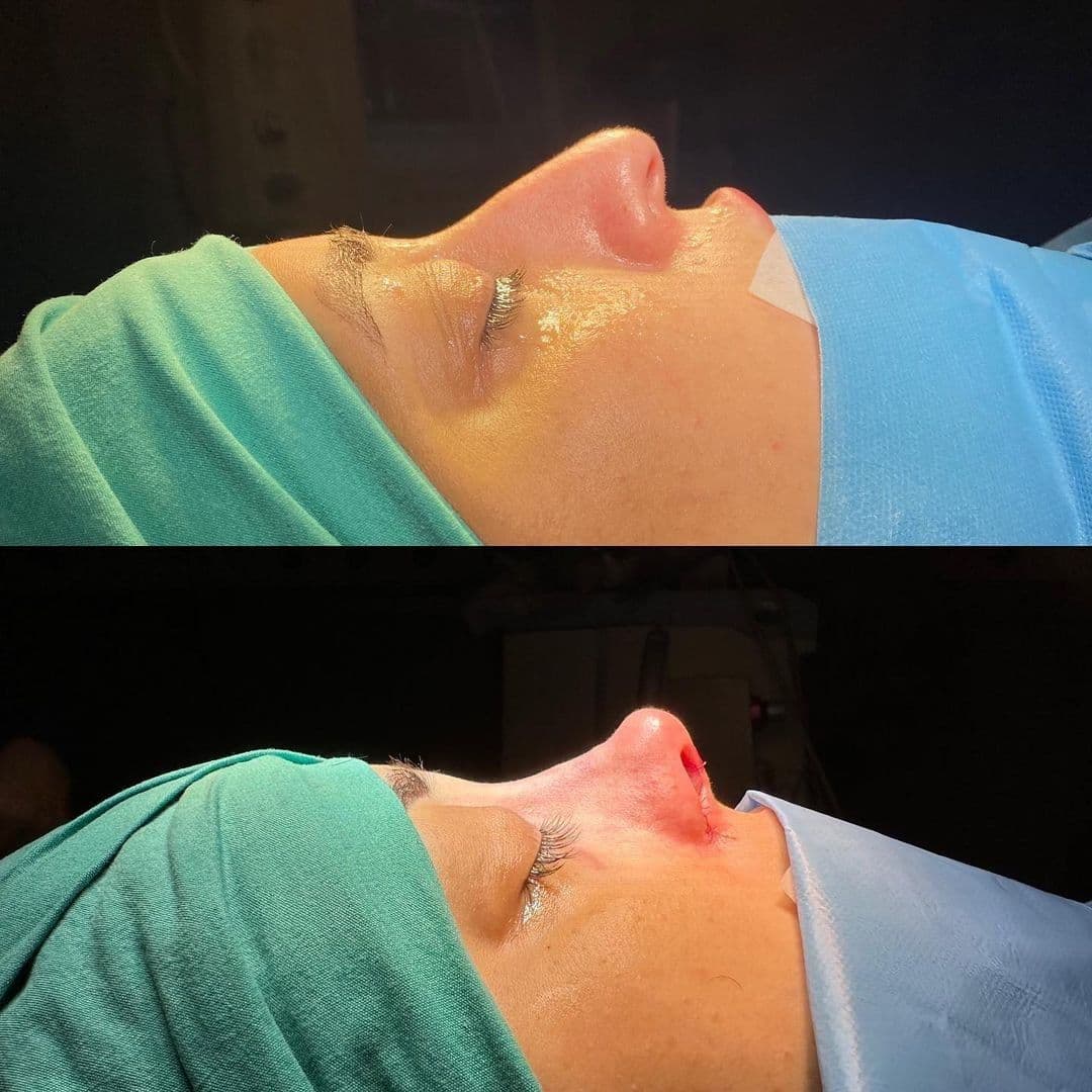 Başarısız Yüz Germe: Ameliyat Öncesi Bilmeniz Gerekenler