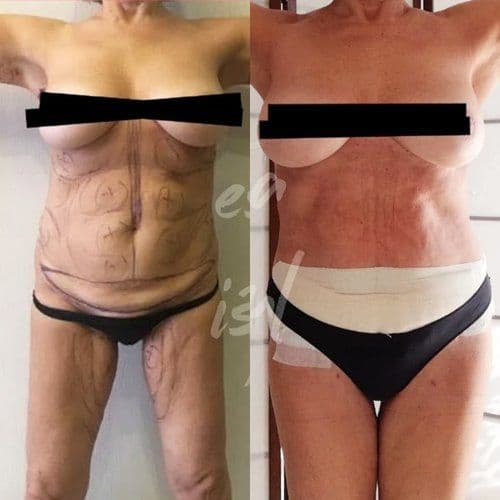 Tummy Tuck Before After